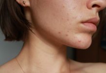 Pimple Patches im Alltag: Kleine Helfer für ein gepflegteres Hautbild Pickel Anti Pickel Pimple