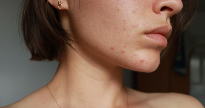 Frau mit Pickel im Gesicht Pickel Anti Pickel Pimple