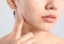 Der große Pickel Patches Ratgeber:Von der Anwendung bis zur Wirkung Pickel Patches Pimple Patches