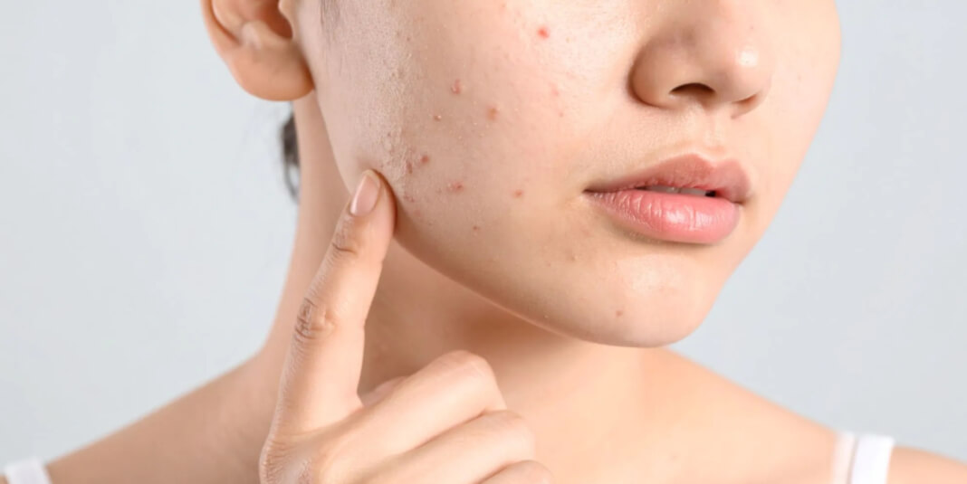 Frau mit Hautunreinheiten Pickel Patches Pimple Patches